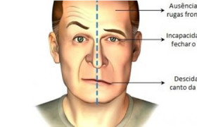 Paralisia facial oto